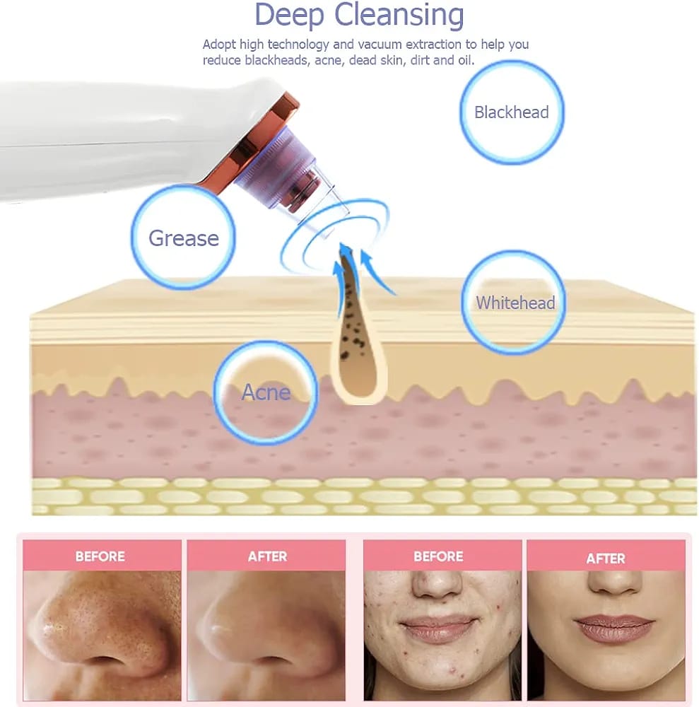 Blackhead Remover