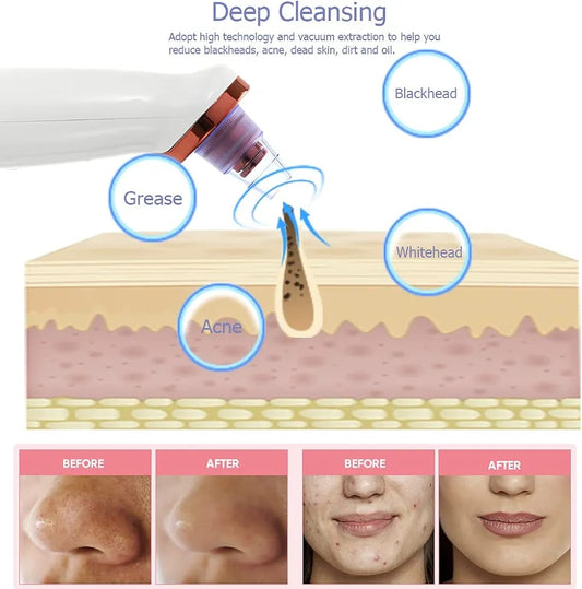 Blackhead Remover